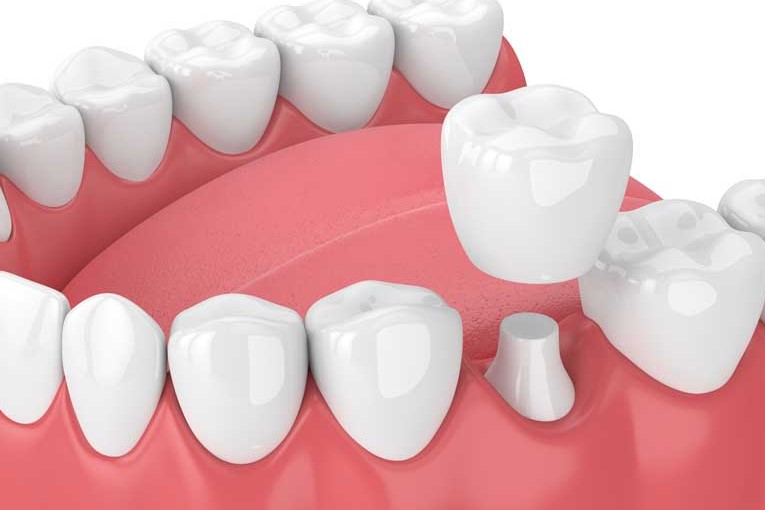 Dental Implant in Canberra