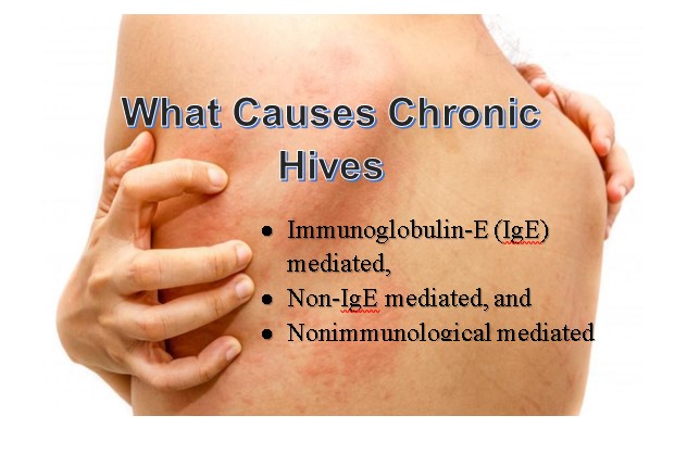 What Causes Chronic Hives