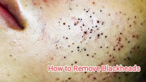 How To Get Rid Of Blackheads