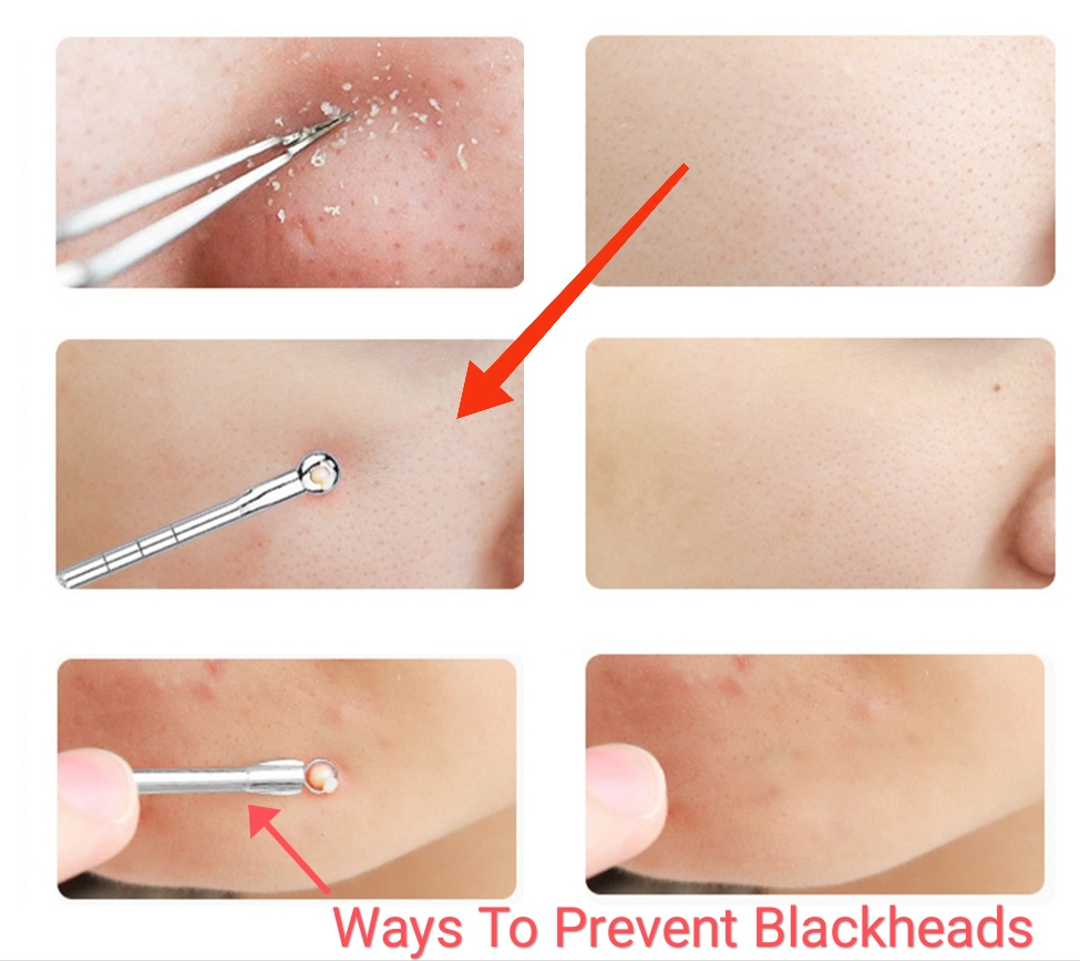 ways-to-prevent-blackheads get rid of blackheads