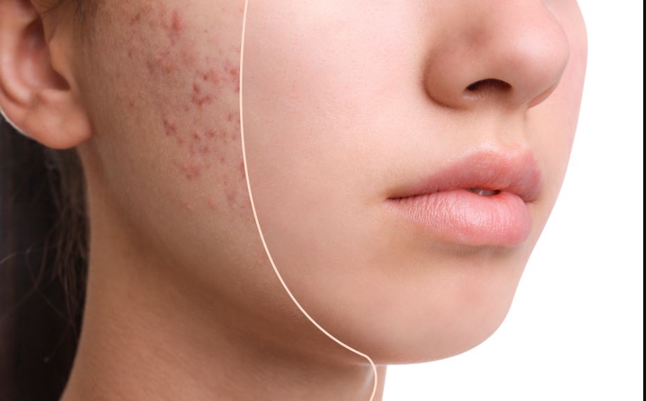 Best Treatment for Acne Scarring with Acne Specialist