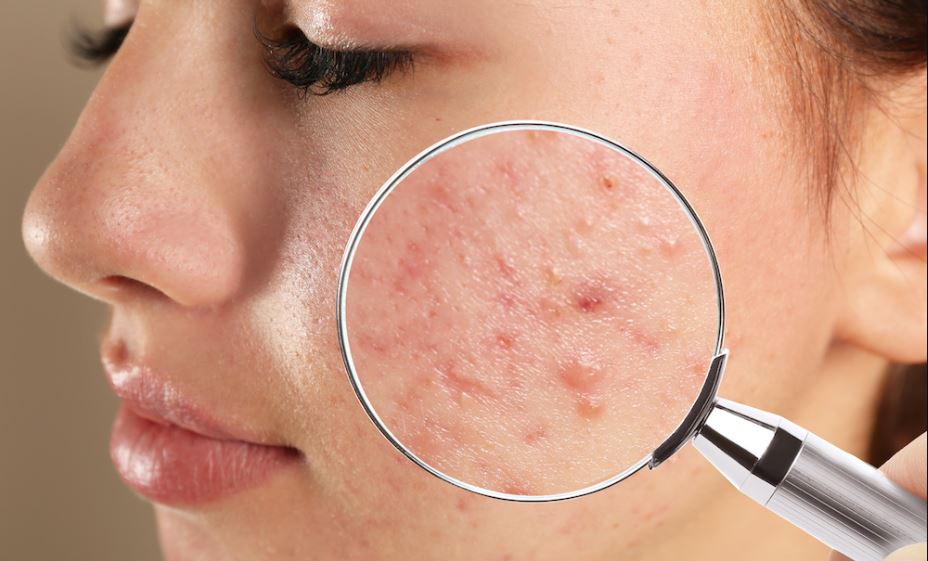 Understanding-Acne-Scarring Best Treatment for Acne Scarring with Acne Specialist