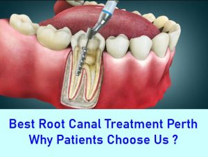 Best Root Canal Treatment Perth