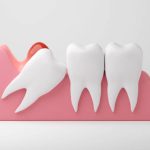 Wisdom tooth infection and inflammation gums on white background, 3D rendering.